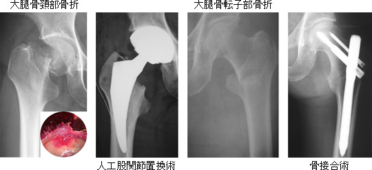 骨折 子 骨 大腿 転 部